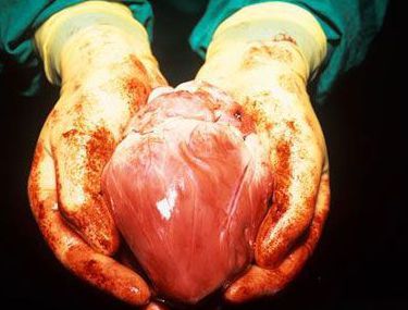 【动物实验】-狒狒体内植入猪心脏后成功存活