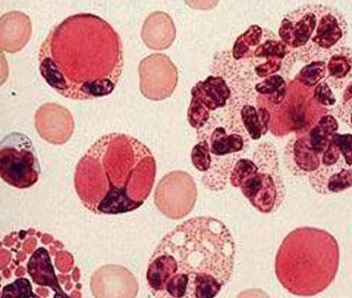 系统性红斑狼疮诊断提升到基因水平