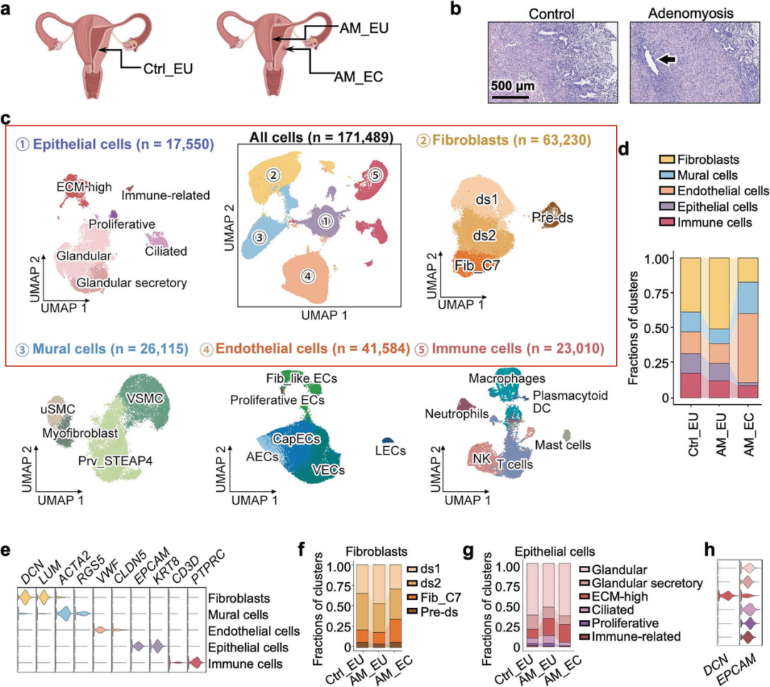 IF53！北大/协和强强联手！发现子宫腺肌病关键致病靶点